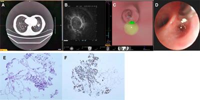 Pilot study of archimedes virtual bronchoscopic navigation system-guided biopsy to diagnose lung nodules in children